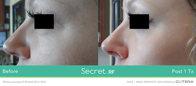 secret rf eyelids cheeks