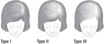 Female Pattern Hair Loss