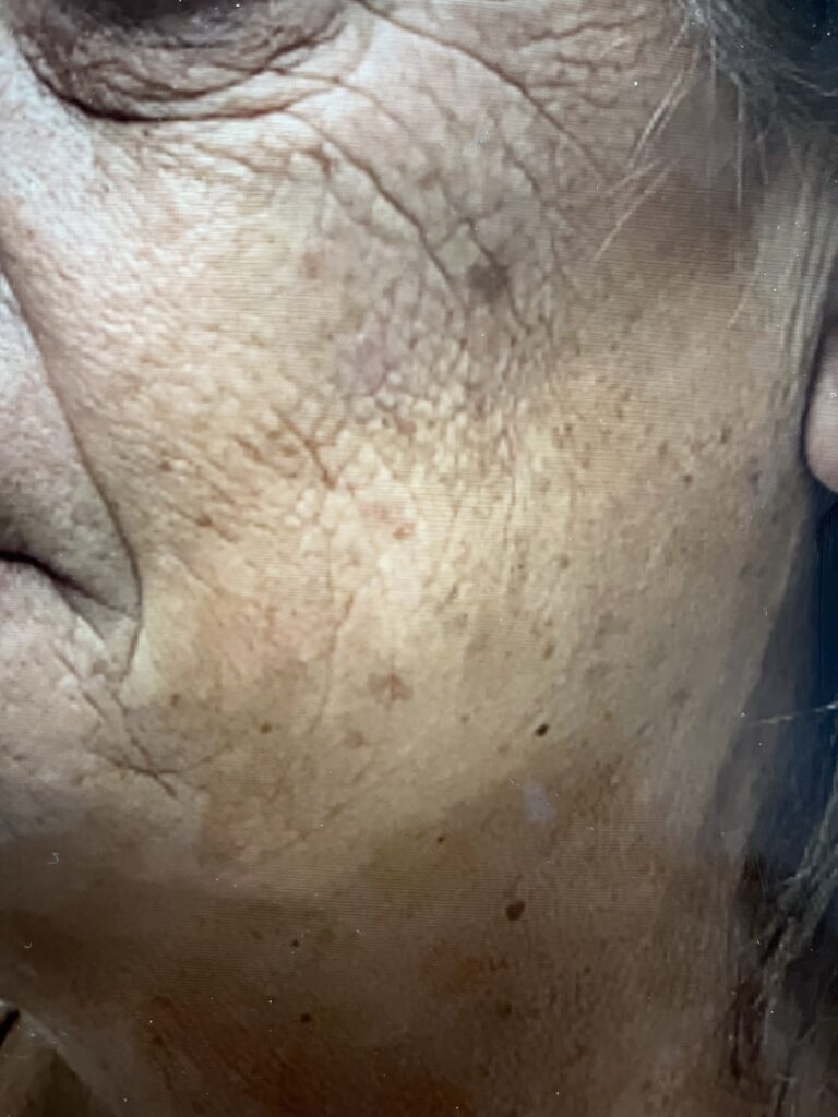 ultherapy after 1 cheek scaled