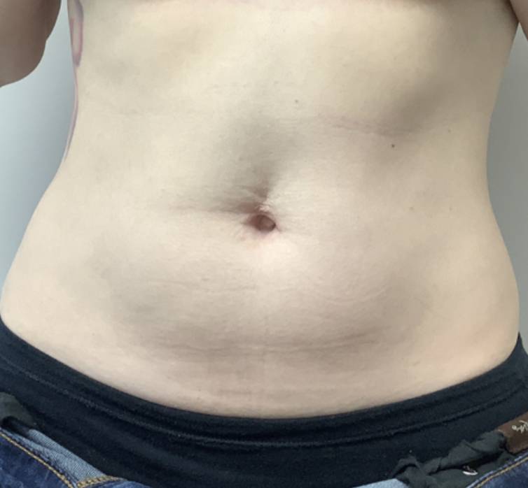 After ONE SESSION Trusculpt iD