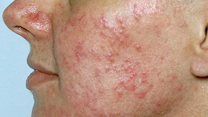 Rosacea Treatment Rsb Dermatology