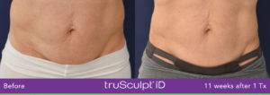 truSculpt iD Abdomen