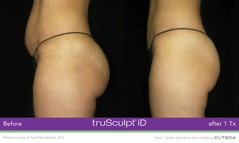 Cool Sculpting Elite-Trusculpt ID