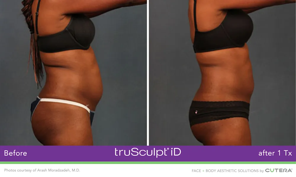 Cool Sculpting Elite-Trusculpt ID