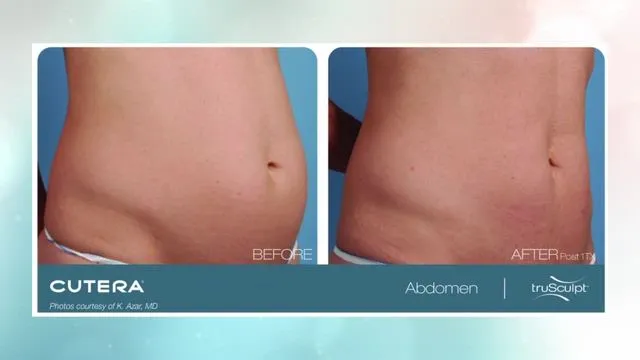 Abdomen fat reduction