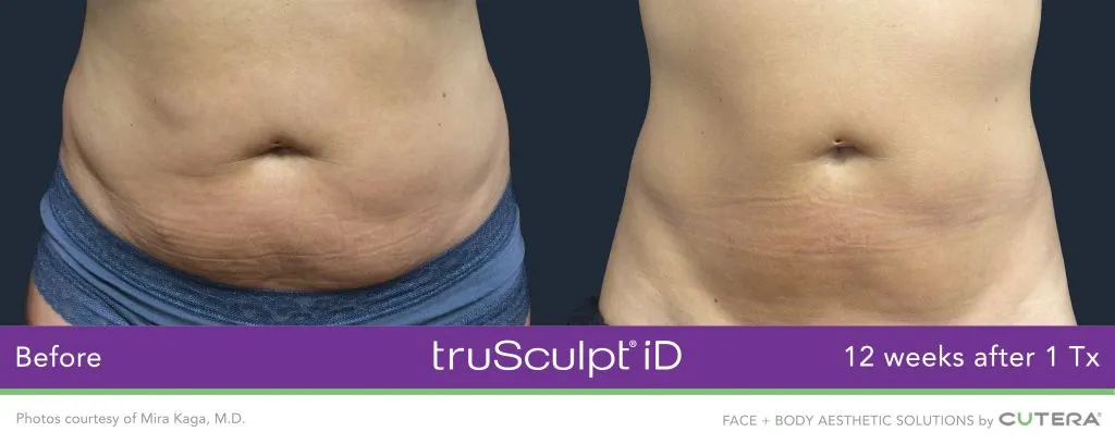 Start TruSculpt Body Contouring Now for the Shape You've Always Wanted by  Summer: Dermatology of Boca: Dermatologists