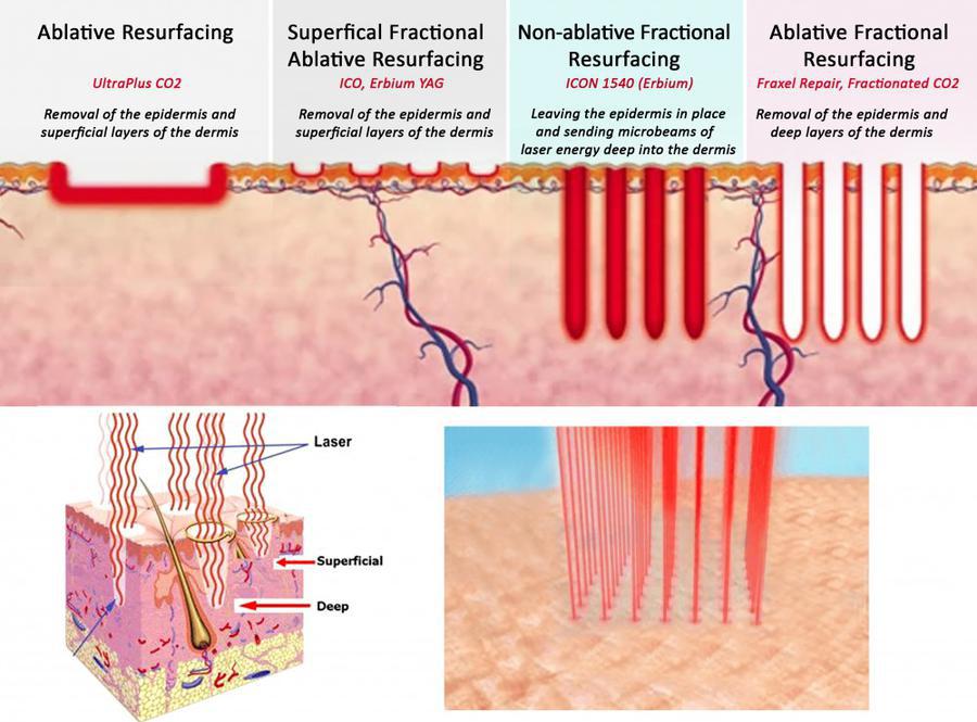 Ablative Laser vs Non-Ablative, AllWhite Laser