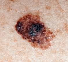 melanoma