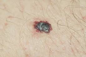 melanomasmall