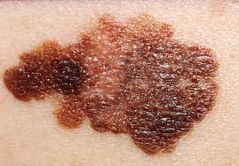 melanomasuperficial