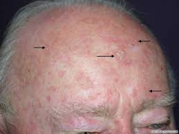 Pictures of Actinic Keratosis, Moles, Nevus, and Psoriasis