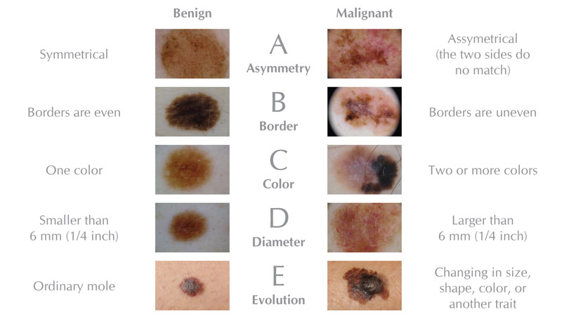 ABCDE of Melanoma